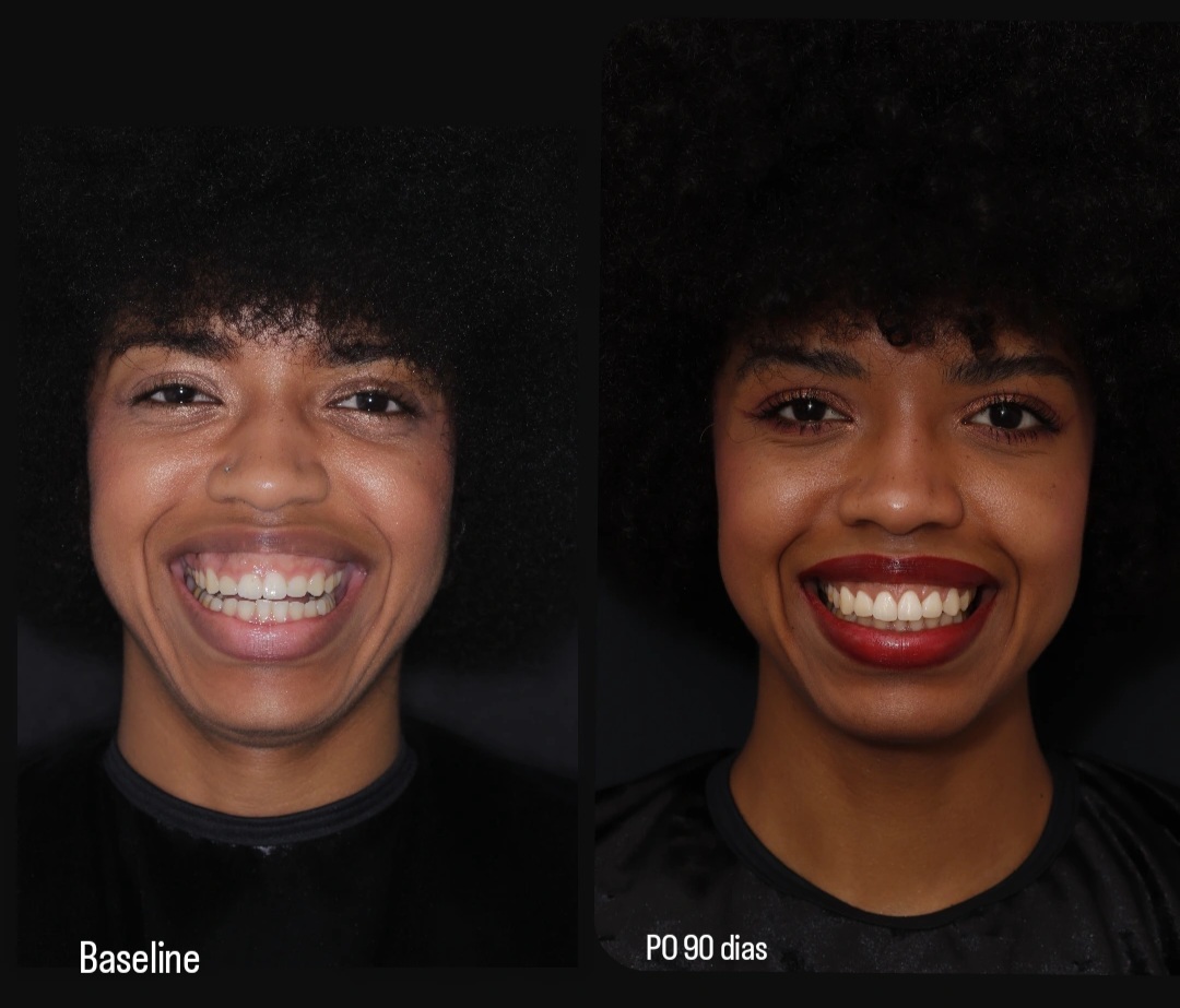 Cirurgia de aumento de Coroa Clínica com adição de enxerto