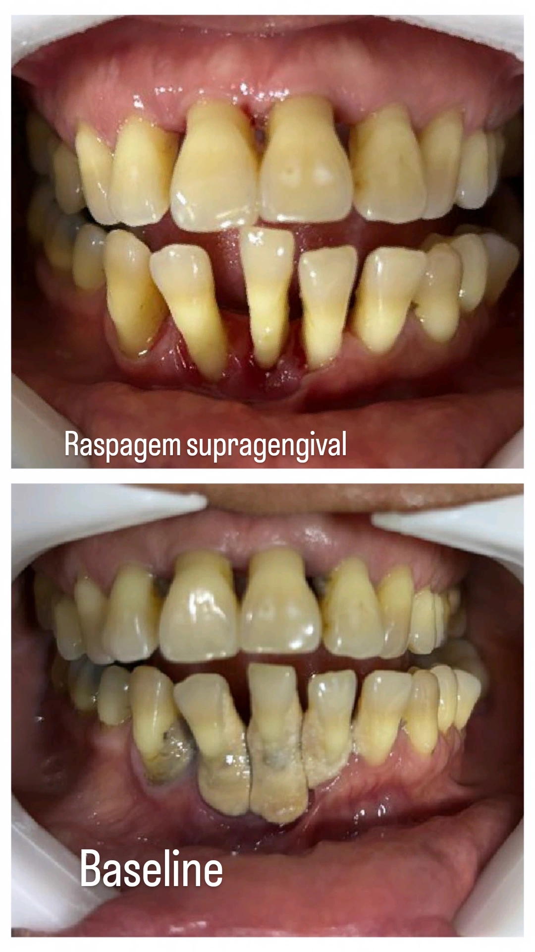 Tratamento da doença periodontal